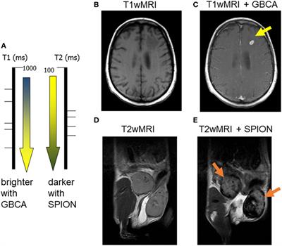 Nanoparticle-Based Magnetic Resonance Imaging on Tumor-Associated Macrophages and Inflammation